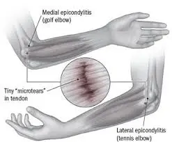 Tennis Elbow Treatment