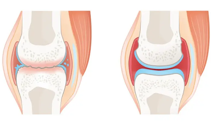 rheumatoid arthritis treatment in Noida